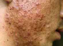 Atrofisk acne