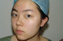 Laser Acne