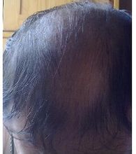 Medfødt alopecia