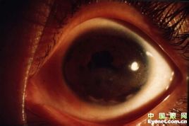 Cornea degeneration