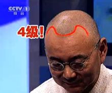 Androgen alopeci