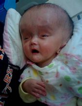 Infant hydrocephalus