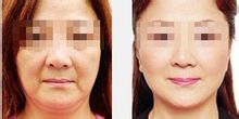 Photorejuvenation