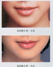 Lip injektioner