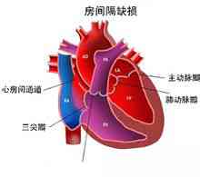 Medfødt hjertesygdom