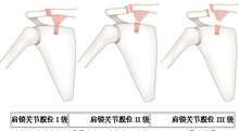 Acromioclavicular dislokation
